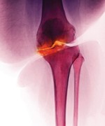 © KALLISTA IMAGES/CUSTOM MEDICAL STOCK PHOTO/GETTY IMAGES